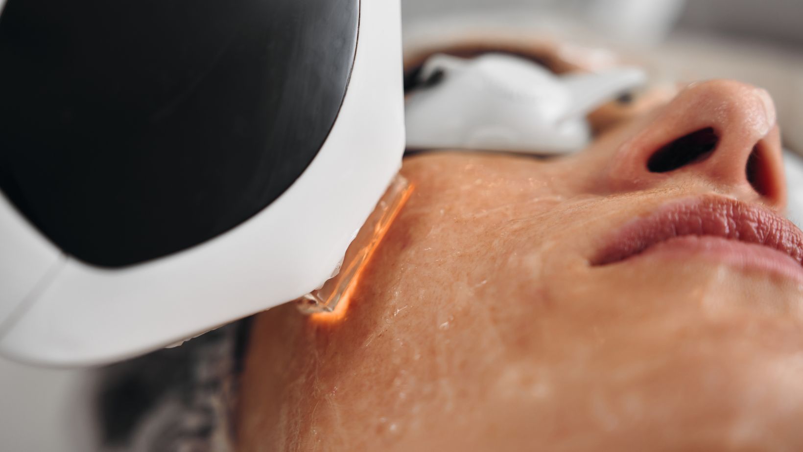 Identity Aesthetics | Aesthetic Treatments IPL Laser Treatment IPL Laser Treatment