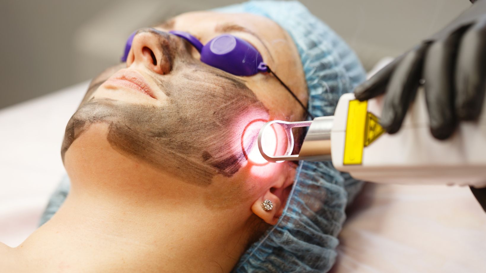 Laser facial rejuvenation is a cutting-edge, non-invasive procedure that utilizes advanced laser technology to revitalize your skin.