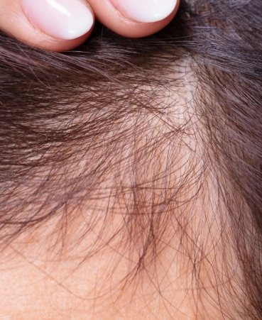 Identity Aesthetics | Aesthetic Treatments Hair Restoration Hair Restoration