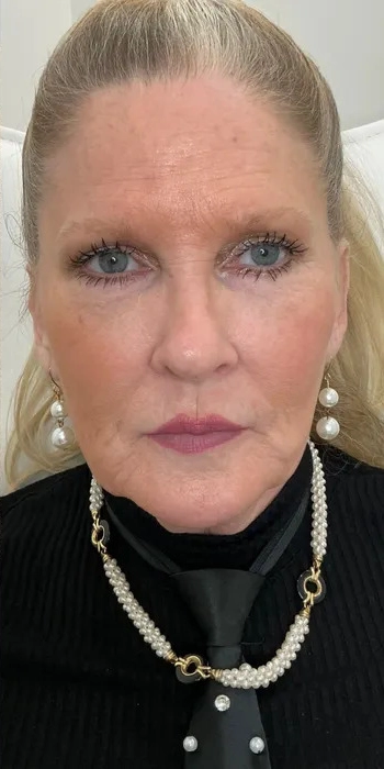 Dermal Fillers Conroe Tx 10 Identity Aesthetics | Aesthetic Treatments Dermal Fillers Conroe TX dermal fillers Conroe TX