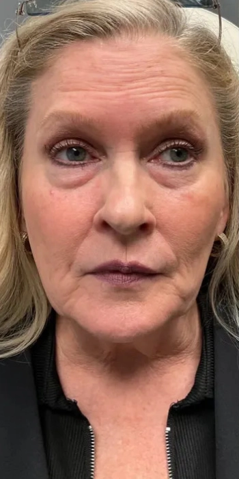 Dermal Fillers Conroe Tx 8 Identity Aesthetics | Aesthetic Treatments Dermal Fillers Conroe TX dermal fillers Conroe TX