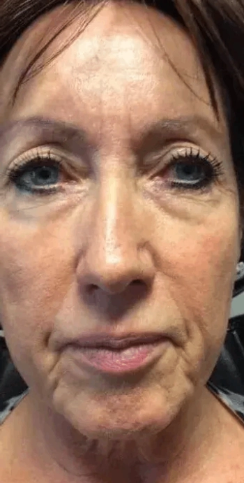 Botox Conroe Tx 8 Identity Aesthetics | Aesthetic Treatments Botox Conroe TX Botox Conroe TX