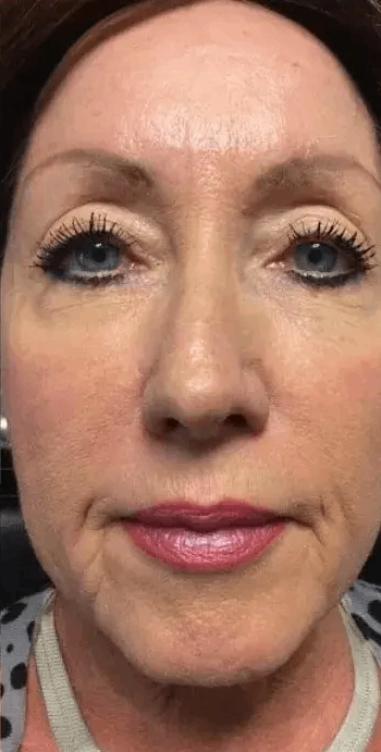 Botox Conroe Tx 10 Identity Aesthetics | Aesthetic Treatments Botox Conroe TX Botox Conroe TX