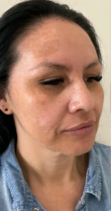 Lip Fillers Conroe Tx 8 Identity Aesthetics | Aesthetic Treatments Lip Fillers Conroe TX lip fillers Conroe TX