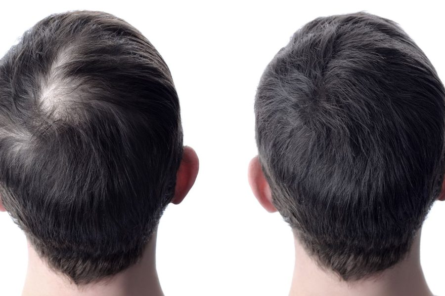 Hair Restoration in texas