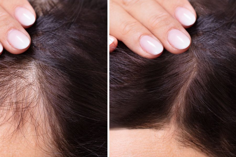 Hair Restoration near me