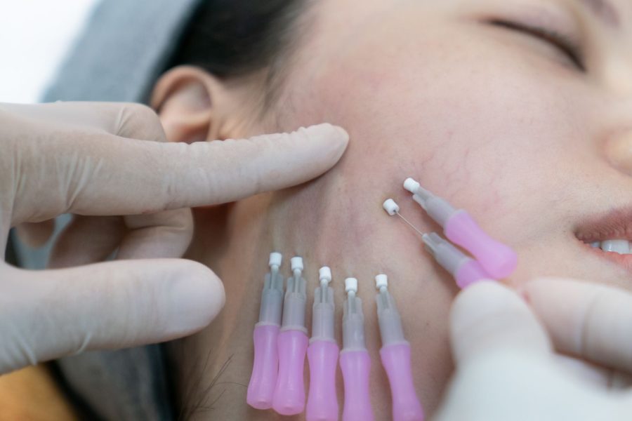 PDO Threads offer a minimally invasive way to achieve a youthful, lifted look—without the downtime of traditional surgery